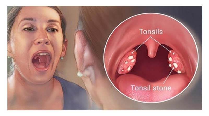 tonsil-stones